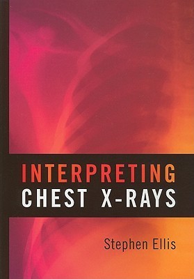 Interpreting Chest X-Rays